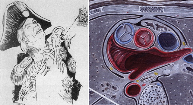 Left: the ball’s track through Nelson's chest and spine, image courtesy of Professor Leslie Le Quesne; Right: The ball’s passage (white line), passing behind the pulmonary artery, image: Michael Crumplin